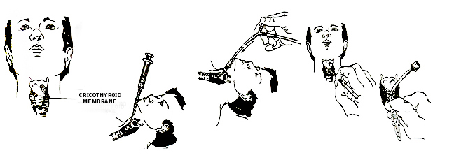 Figures illustrating cricothyroidotomy