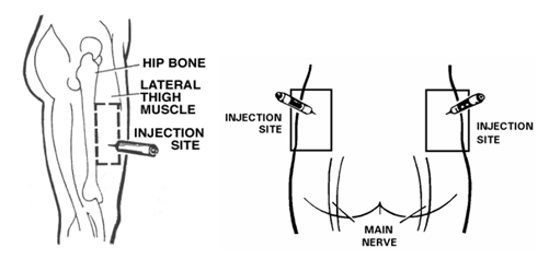 Injections given to the outer thigh muscle and upper outer quadrant of the buttocks